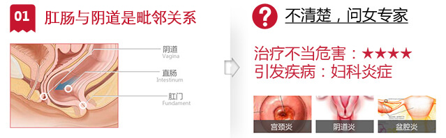 肛肠疾病引发妇科炎症