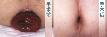 脱肛的治周期果0.jpg