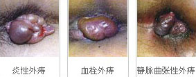 外痔的 治疗方法