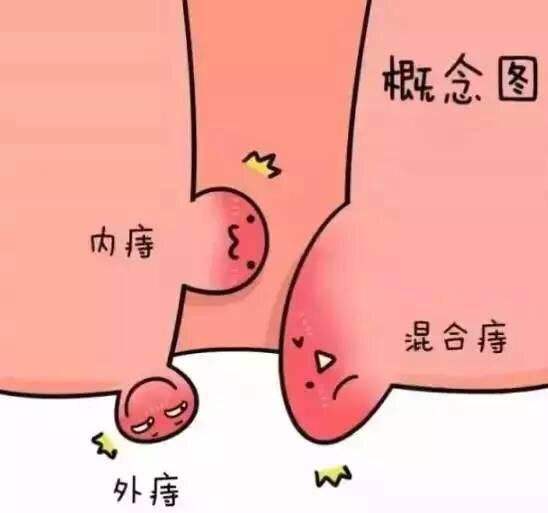 吃鸡正High 却吃出了痔疮来袭！广州东大医院口碑