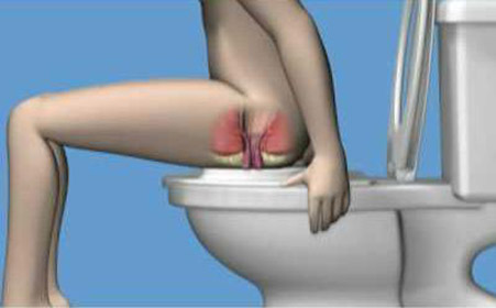 如厕太久易脱肛 广州东大医院收费怎么样